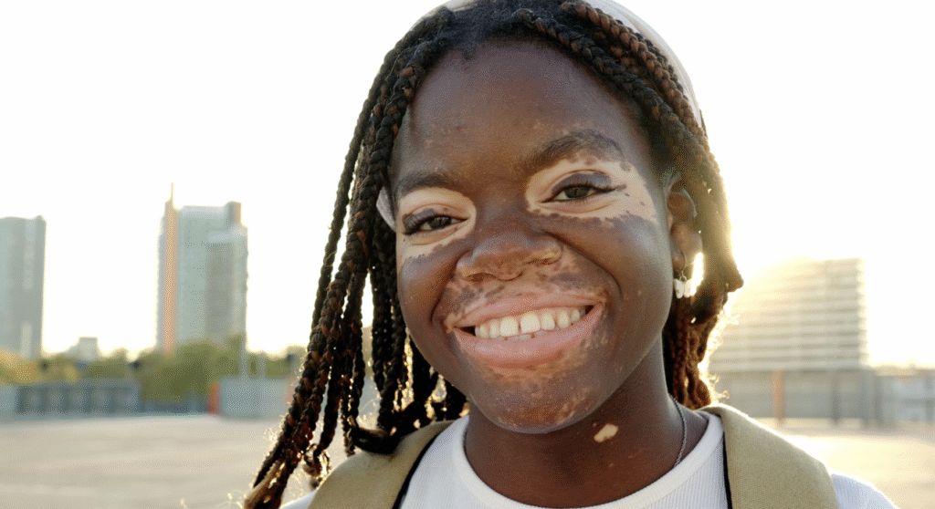 Vitiligo: una enfermedad visible, pero poco comprendida