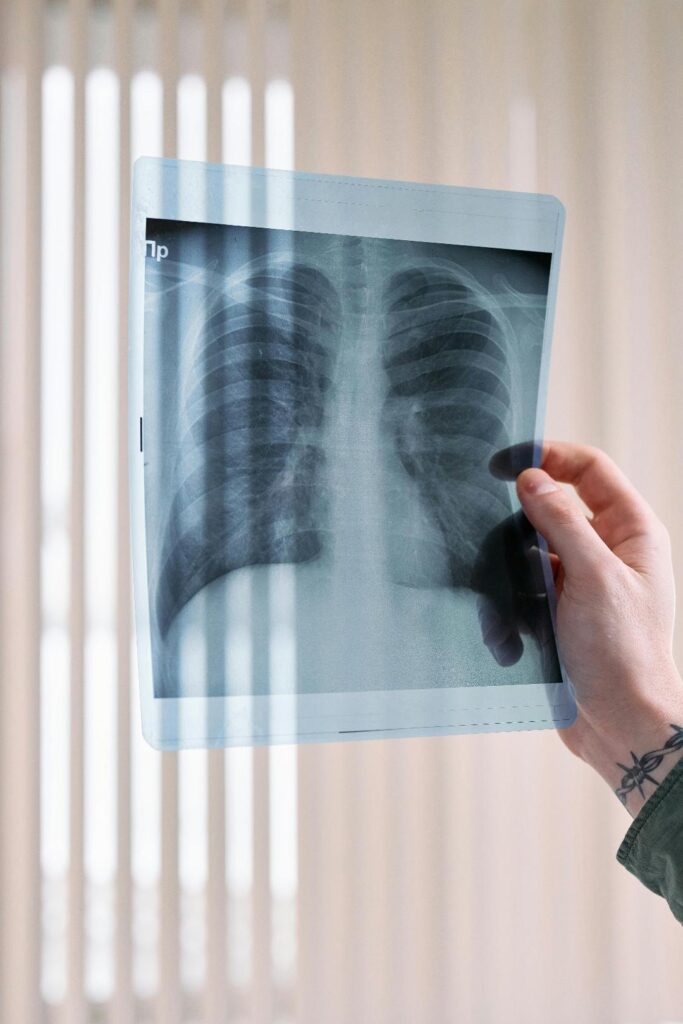 Innovadora molécula de Boehringer Ingelheim frena deterioro en Fibrosis Pulmonar