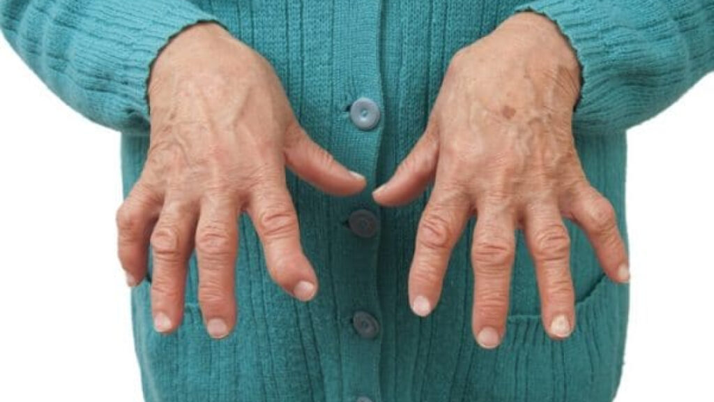 La artritis reumatoide afecta mucho más que las articulaciones: hasta 1 de cada 2 pacientes sufre síntomas depresivos