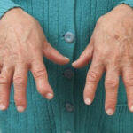 Seropositive-Rheumatoid-Arthritis-1-1100×619