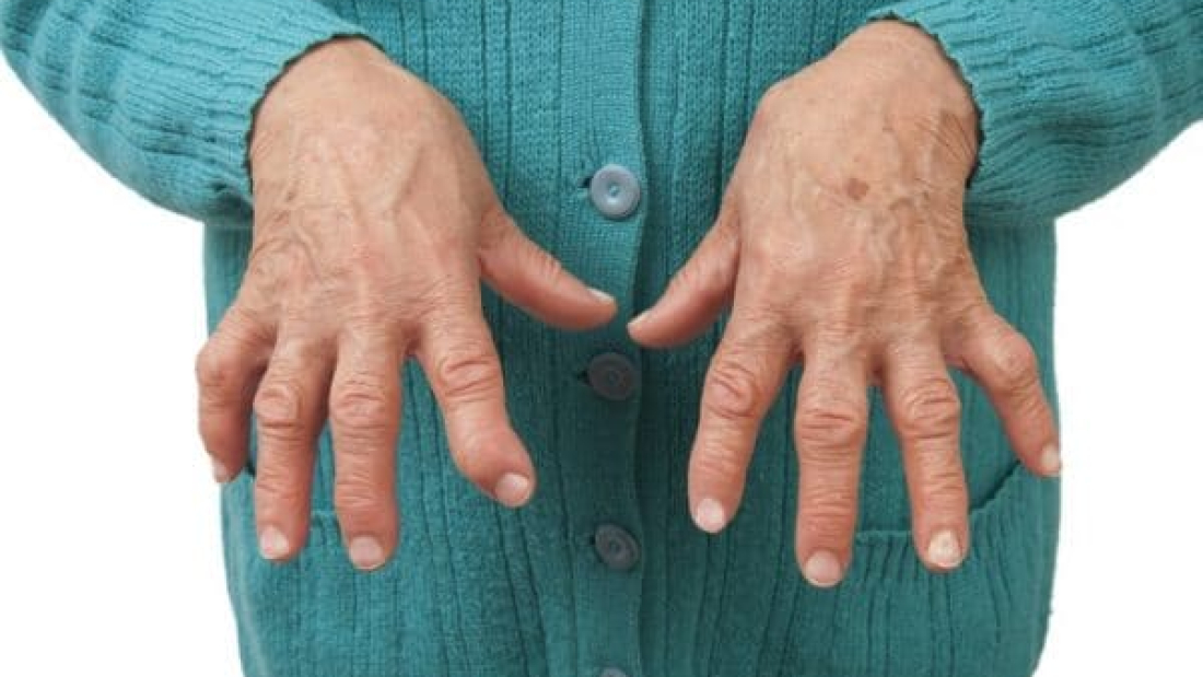 Seropositive-Rheumatoid-Arthritis-1-1100×619