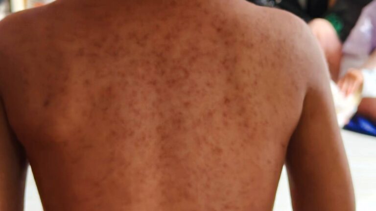 getty-images-sarampion-185855