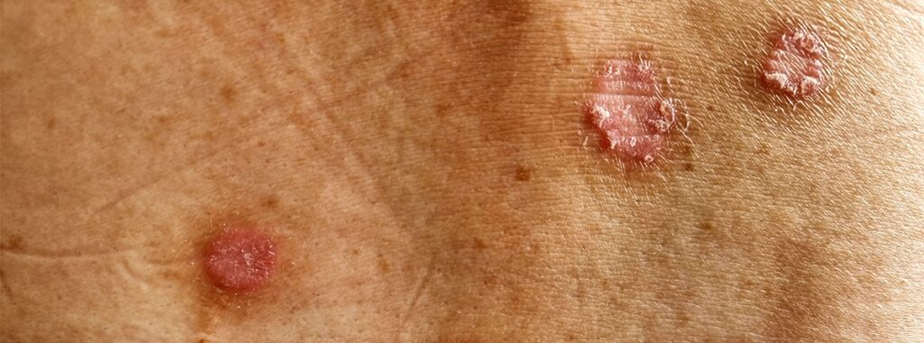 31 millones de personas en México viven con alguna enfermedad de la piel. ¿Cómo reconocer la Hidradenitis Supurativa?