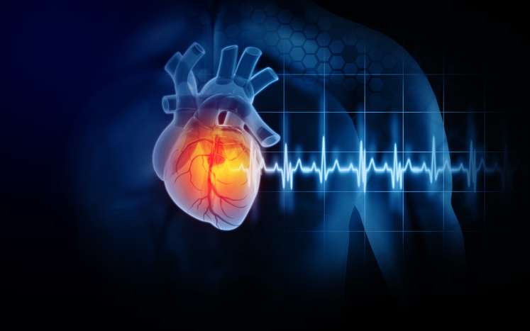 El 44% de los pacientes de Infarto Cerebral podrían padecer secuelas