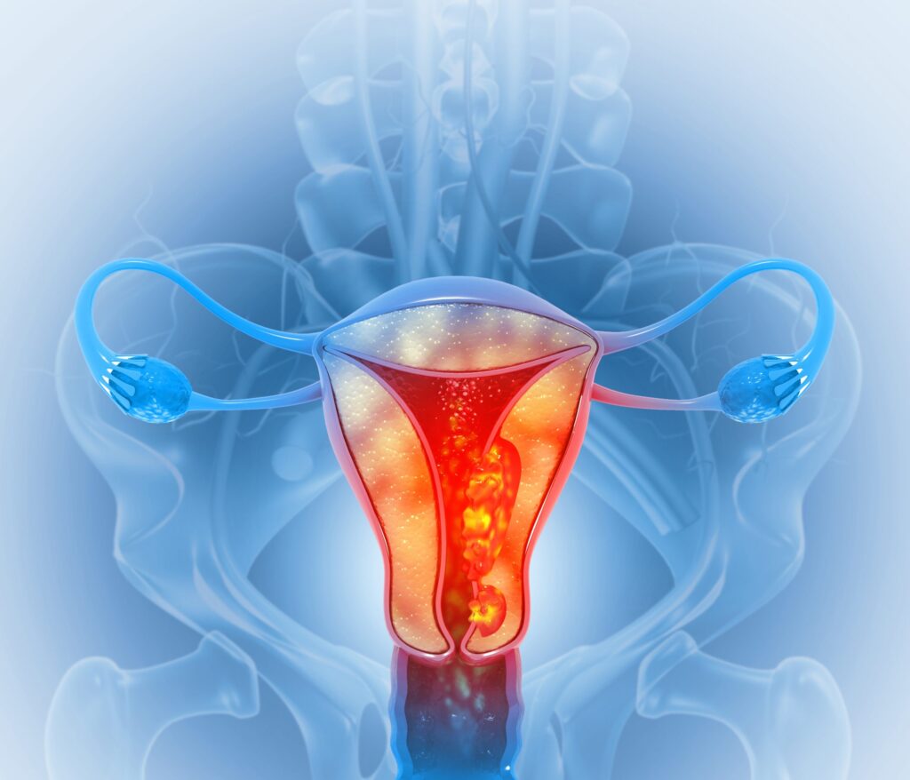 Cáncer ginecológico: tratamientos menos agresivos con la misma eficacia